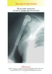 Inmasters catalog - modular shoulder joint endorosthesis 